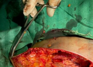 जिला अस्पताल में पिछले पखवाड़े में हुए सौ से अधिक नि:शुल्क ऑपरेशन, ओपीडी भी बढ़ी