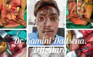 दुर्ग: जटिल पैनफेशियल फ्रैक्चर का पहली बार जिला अस्पताल में डॉ.कामिनी डडसेना द्वारा किया गया सफलतापूर्वक इलाज